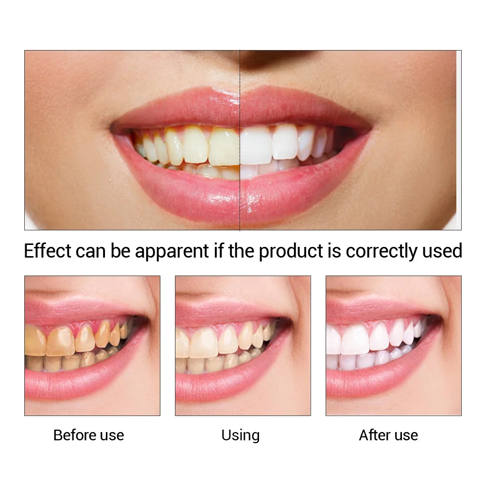 FTEENPLY Teeth Whitening Essen - огляд і ціна Teeth Whitening Ulta
