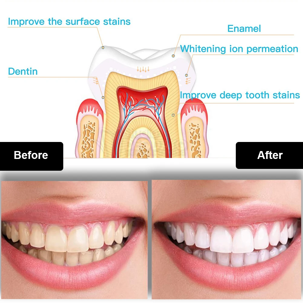 Dental Teeth Whitening Kit Min - огляд і ціна Teeth Whitening Ulta