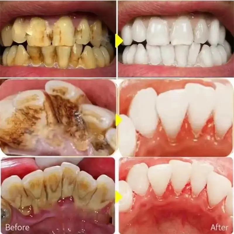 Fast Teeth Whtening Toothpaste - огляд і ціна Whitening Pen Bleach